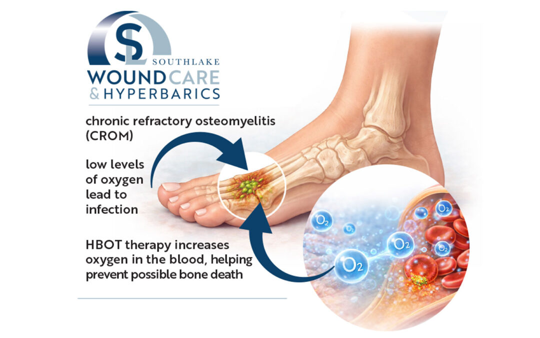 Hyperbaric Oxygen Therapy for Osteomyelitis